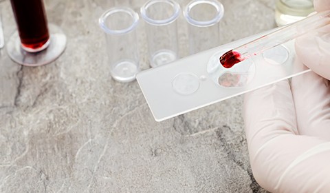É possível detetar alzheimer com uma análise de sangue?